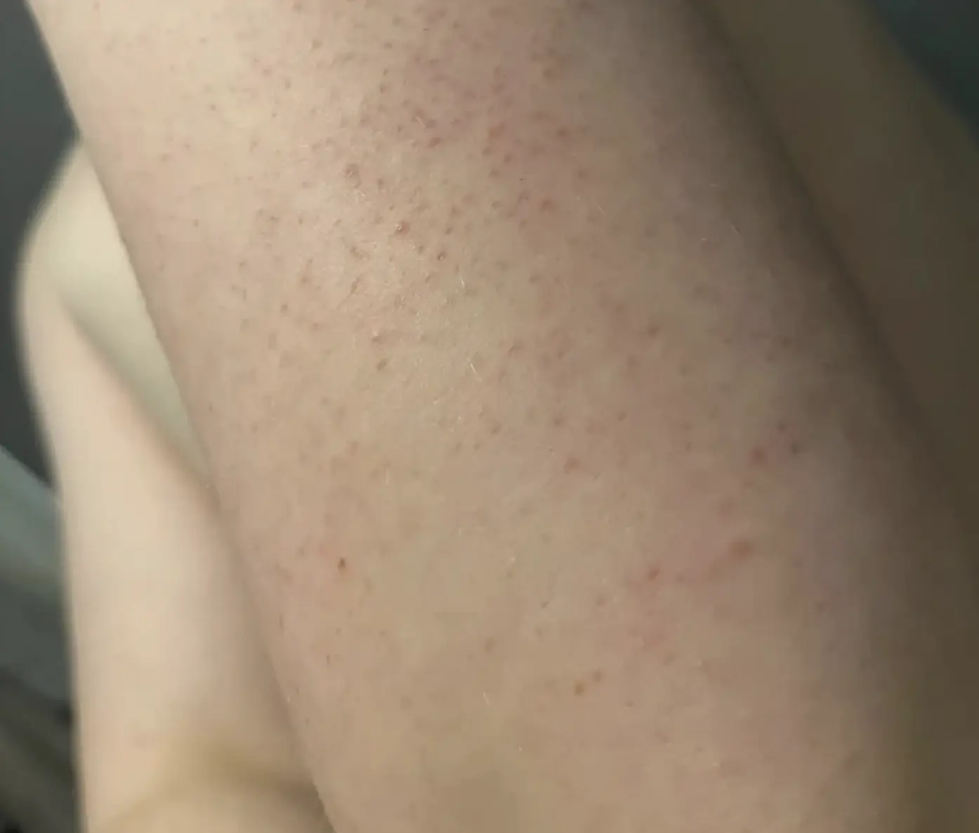 Laser Carbon Peels