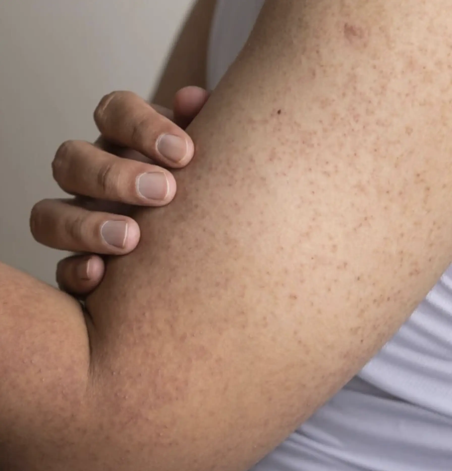 how to get rid of chicken skin on arms