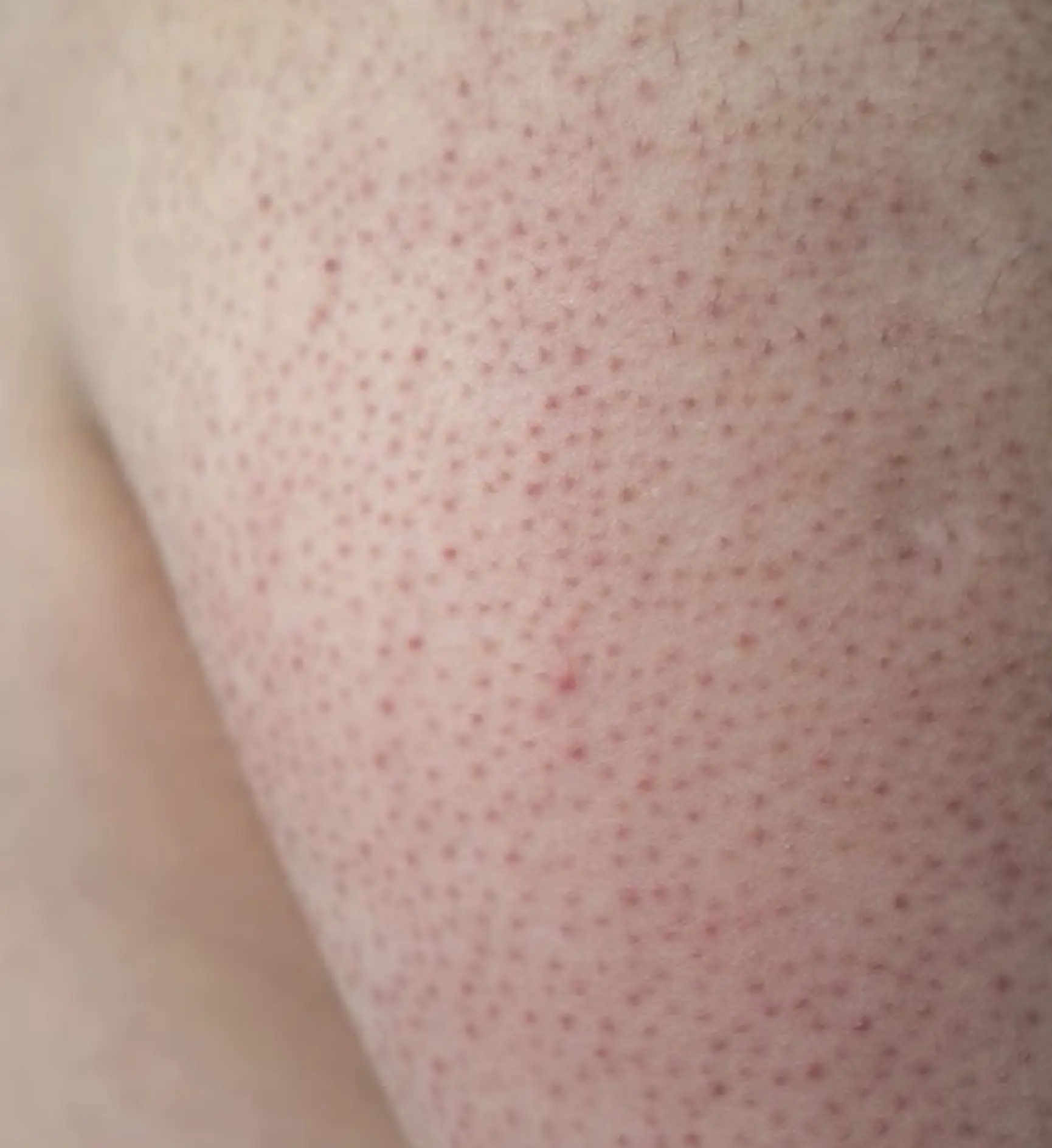 keratosis pilaris treatment arms and legs