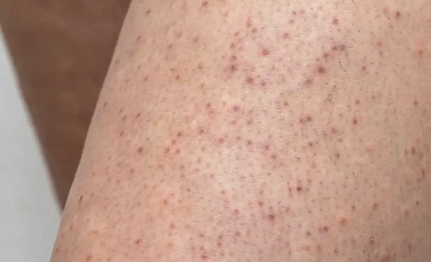 lactic acid for keratosis pilaris treatment