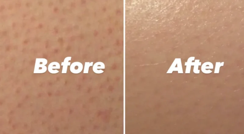 what actually helps keratosis pilaris on arms and legs